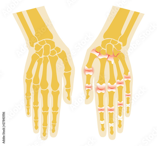 Rheumatoid arthritis bone hand. Palm and fingers. Vector image on white background. Flat design.