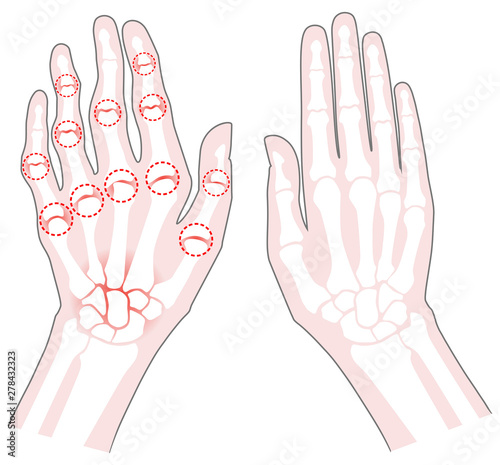 Rheumatoid arthritis bone hand. Palm and fingers. Vector image on white background. Flat design.