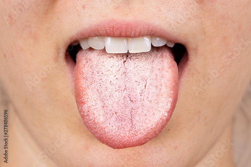 A close up view on the white furry tongue of a young Caucasian girl. A common symptom of a candida albicans yeast infection.