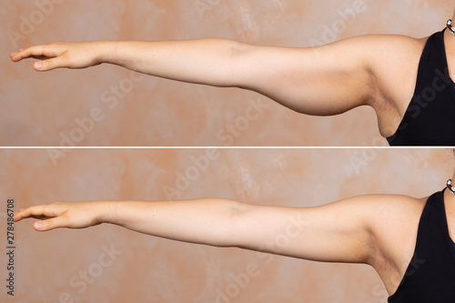 Schilderij op canvas A before and after view of a young Caucasian lady who had a brachioplasty