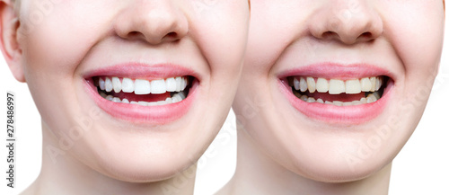 Teeth of young woman before and after whitening and buildup.