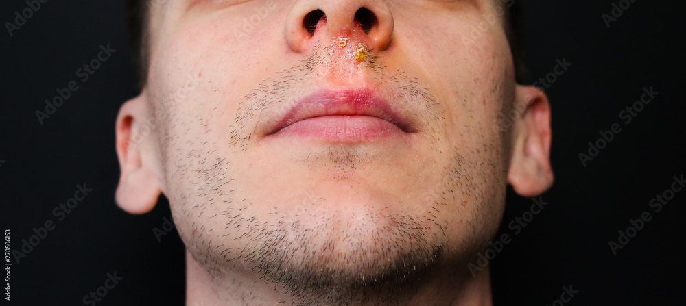 Cold sore in nose treatment online