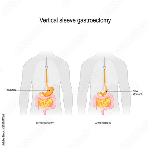 Vertical sleeve gastroectomy. before and after surgery. weight loss surgery