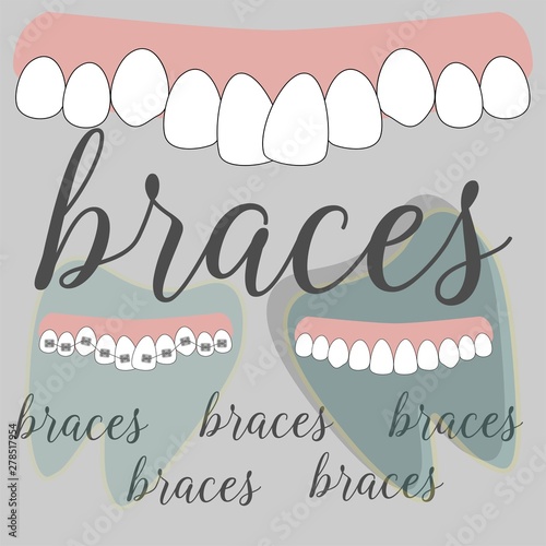 Braces dentistry in beautiful style. Vector flat design illustration.