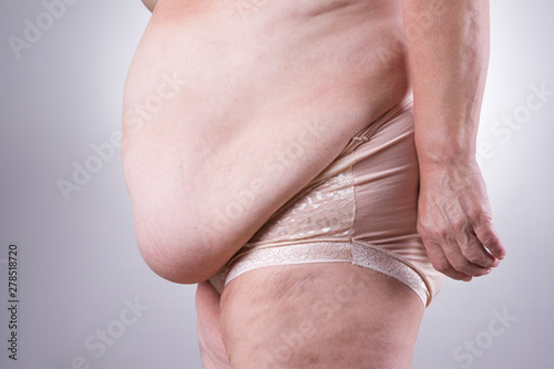 Tummy tuck, flabby skin on a fat belly, plastic surgery concept