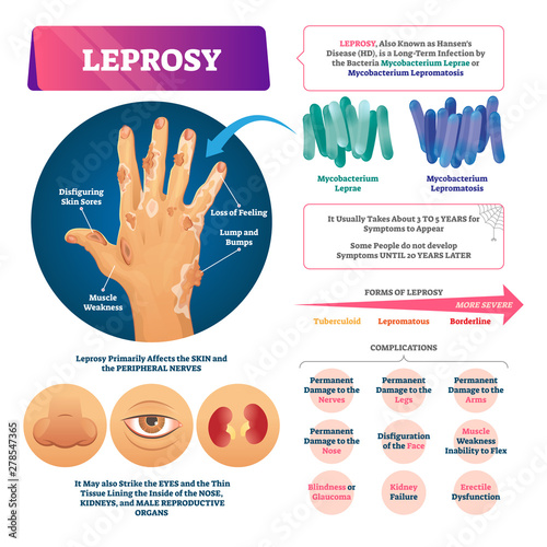 Vászonkép Leprosy vector illustration