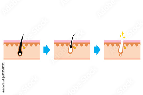 毛根の断面図 Hair scalp growth and removal
