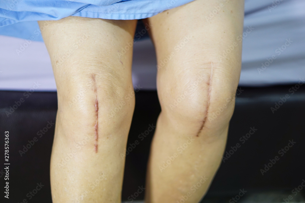 Fototapeta premium Asian senior or elderly old lady woman patient show her scars surgical total knee joint replacement Suture wound surgery arthroplasty on bed in nursing hospital ward : healthy strong medical concept.