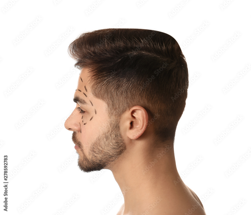Young man with marks on face for cosmetic surgery operation against white background Young man with marks on face for cosmetic surgery operation against white background