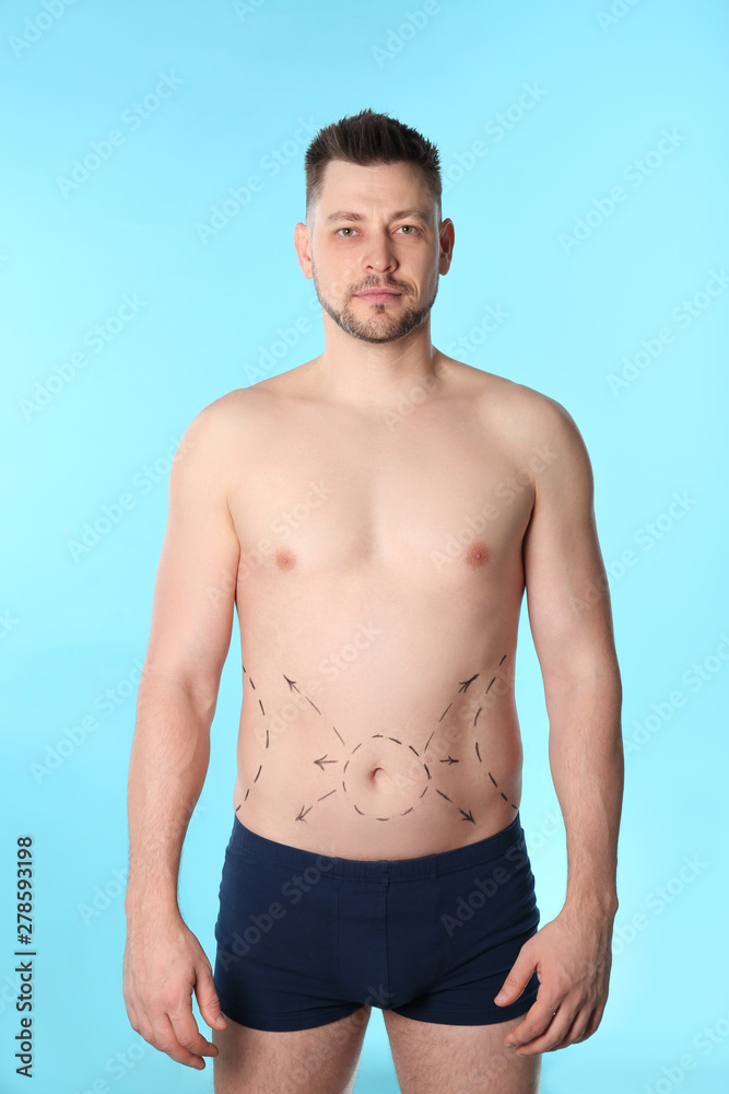 Man with marks on belly for cosmetic surgery operation against blue background Man with marks on belly for cosmetic surgery operation against blue background