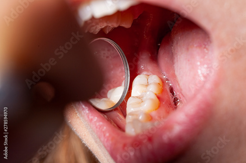 temporary filling of a tooth caries patient photo