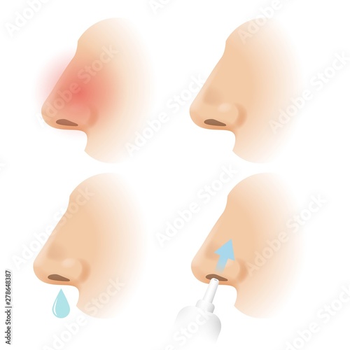 Nose, runny nose and rhinitis, cold medicine, nasal spray