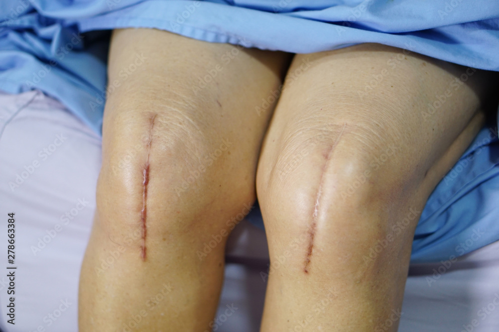 Asian senior or elderly old lady woman patient show her scars surgical total knee joint replacement Suture wound surgery arthroplasty on bed in nursing hospital ward : healthy strong medical concept. Asian senior or elderly old lady woman patient show her scars surgical total knee joint replacement Suture wound surgery arthroplasty on bed in nursing hospital ward : healthy strong medical concept.