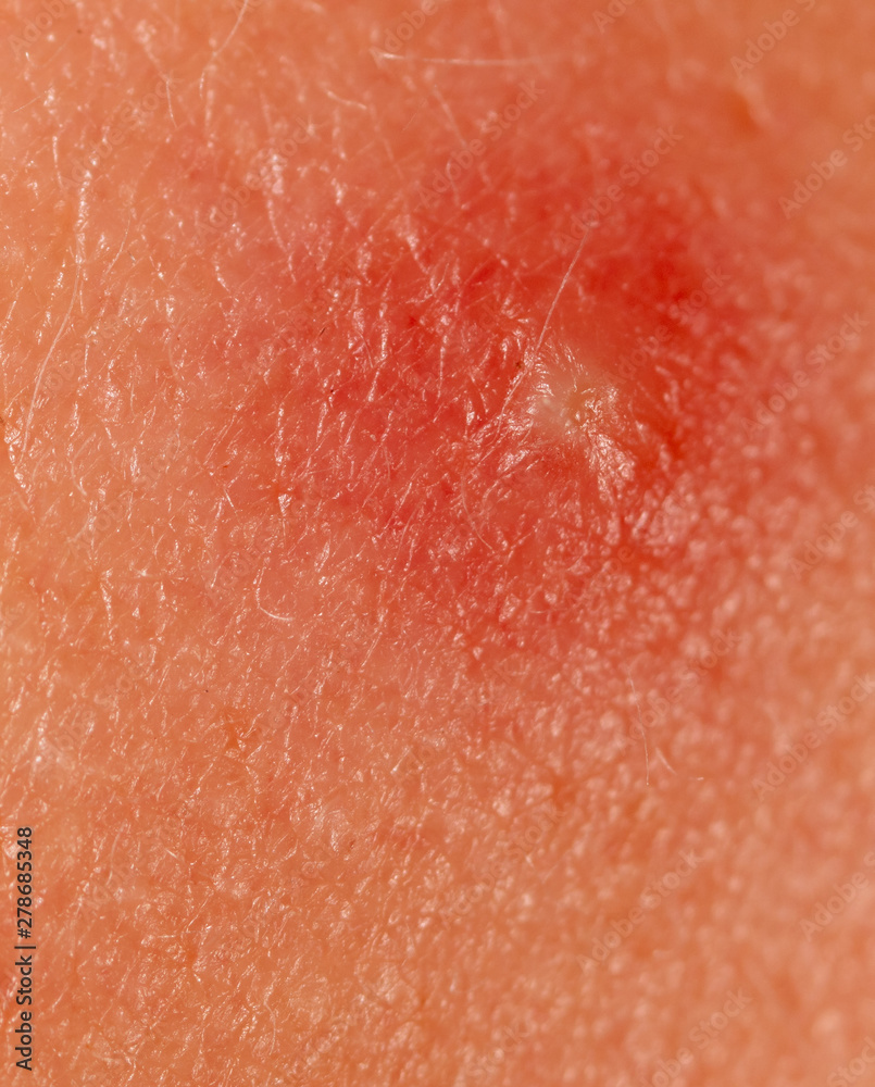 Fototapeta premium Little wound on human skin