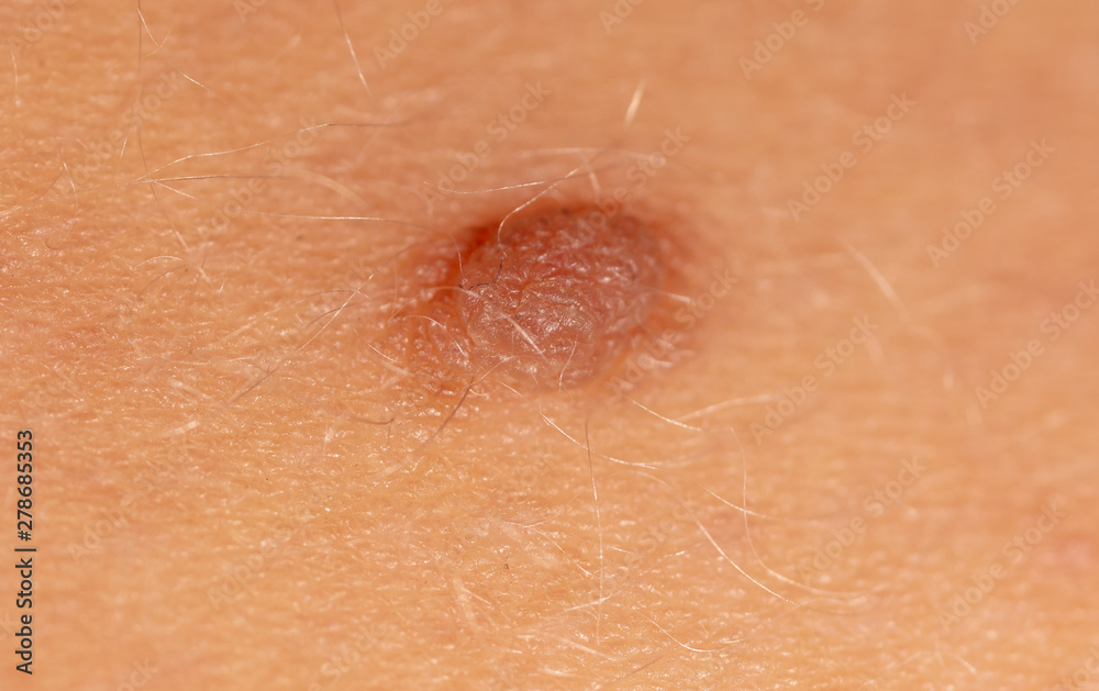 Fototapeta premium Birthmark on human skin as a background