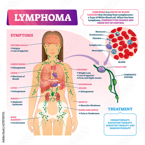Lymphoma vector illustration. Labeled educational blood cancer type scheme.