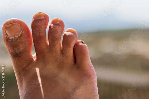 a foot of an adult man with a rough hardened skin, marks from wearing flip flops and a damaged little finger with dried blood and perhaps an infection. photo