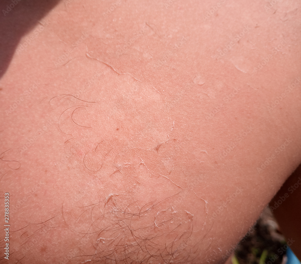 Exfoliation of the skin after sunburn. Excessive tan.