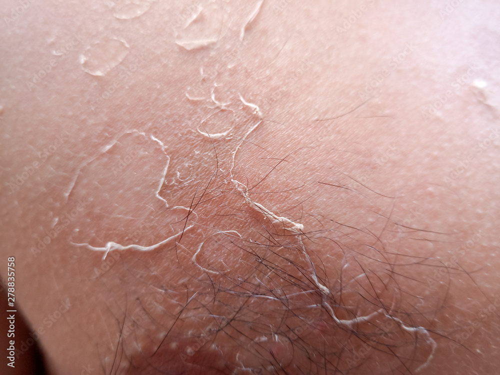 Fototapeta premium Exfoliation of the skin after sunburn. Excessive tan.