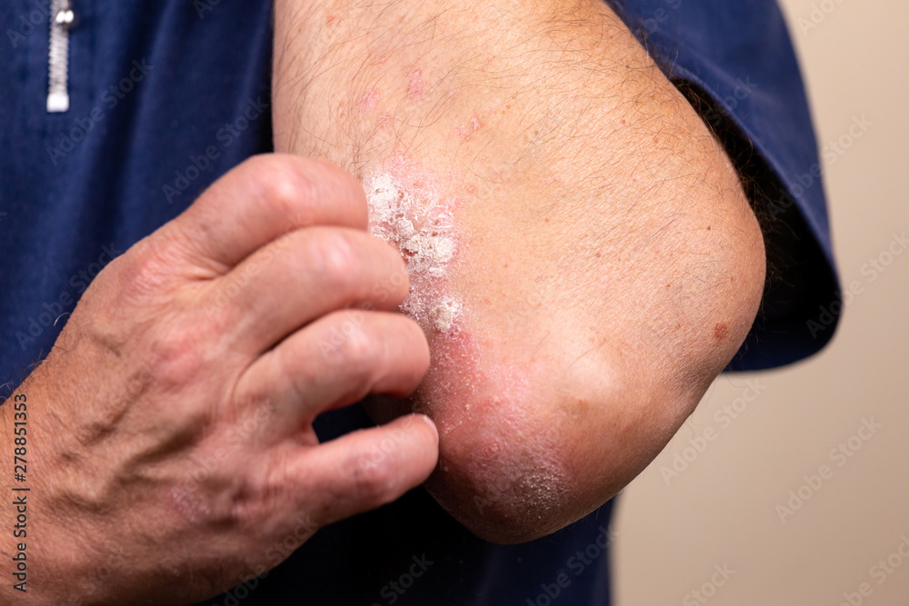 Close up dermatitis on skin, ill allergic rash dermatitis eczema of patient , atopic dermatitis symptom skin detail texture , Fungus The concept dermatology, treatment fungal and fungal