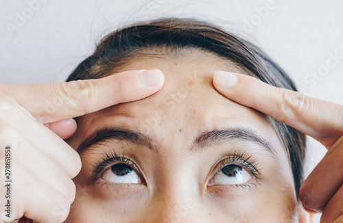 Close up of woman pointing on her forehead with redness acne problems on her skin. Conceptual of skin problems on female skin.
