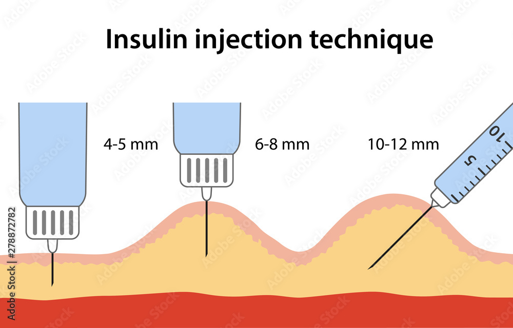 Insulin injection technique for diabetes depending on needle length