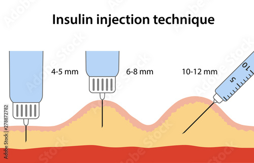 Insulin injection technique for diabetes depending on needle length. Anatomical vector illustration in flat style isolated over white background.
