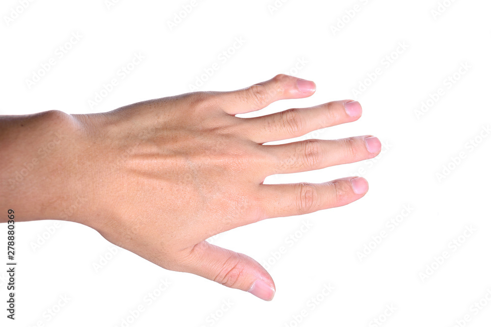 The left hand little finger or pinky finger is deformity isolated on white background. The left hand little finger or pinky finger is deformity isolated on white background.