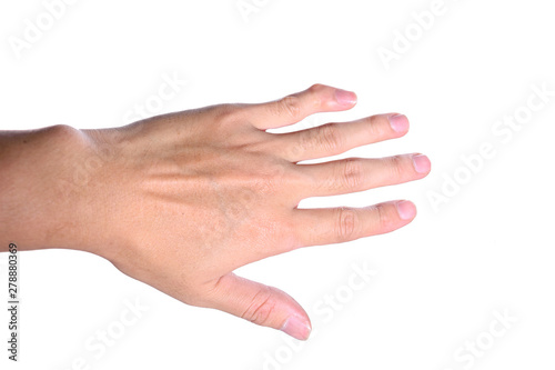 The left hand little finger or pinky finger is deformity isolated on white background.