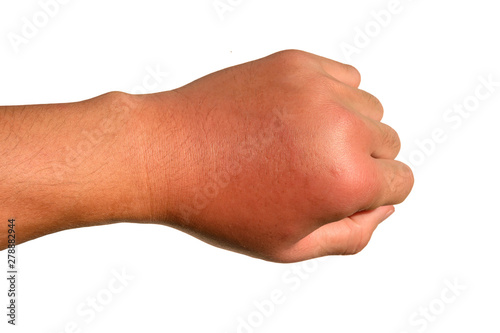 Inflammation, swelling, redness of the hand shows infection. Insect bites. Cellulitis at left hand isolated on white background. photo