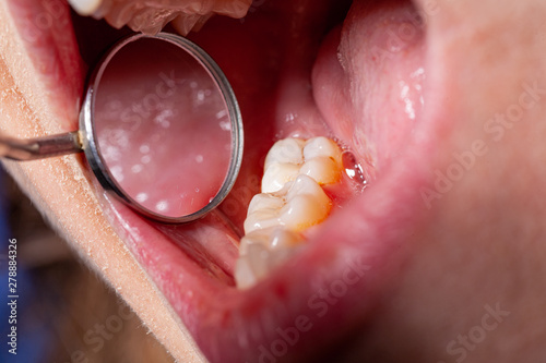 temporary filling of a tooth caries patient
