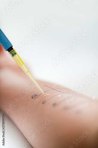 Allergy - Skin Prick Testing photo