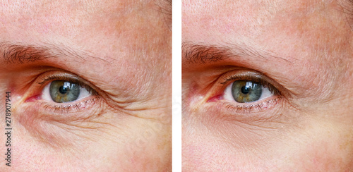 Procedure for the rejuvenation of wrinkles around the eyes, crow's feet,  before and after effect photo
