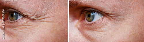 Procedure for the rejuvenation of wrinkles around the eyes, crow's feet,  before and after effect photo