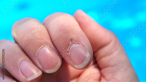 Badly torn cuticles on finger nails photo
