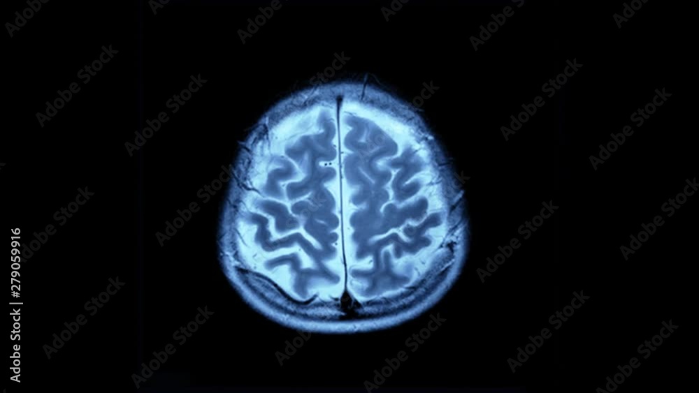 Scanned brain scan image by mri scanner on screen computer. Stock Video ...