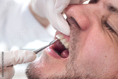 Końcówka ekskawatora dotyka szczeliny między zębowej podczas przeglądu zębów u stomatologa. Twarz białego mężczyzny z lekkim zarostem leży na fotelu podczas badania. 