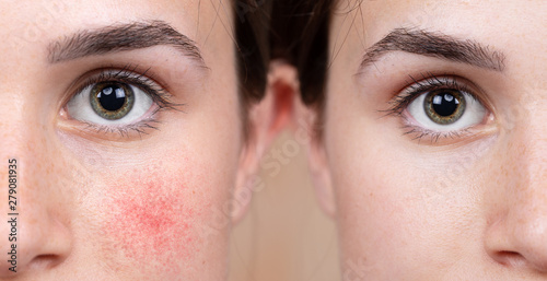 A young Caucasian girl shows the before and after results of intensive light surgery to remove the symptoms of rosacea. A noticeable reduction in cheek redness is seen.