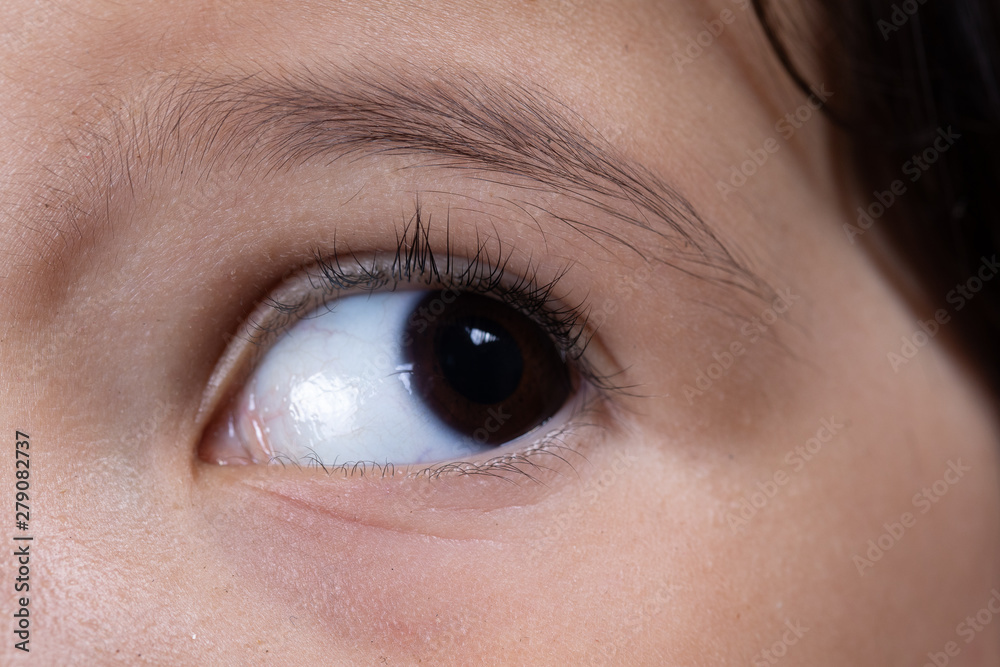 Obraz premium A macro view on the eye of a young child suffering from Aniridia. A disorder in which the iris is absent from the eye. A congenital disorder causing a defect in iris development.
