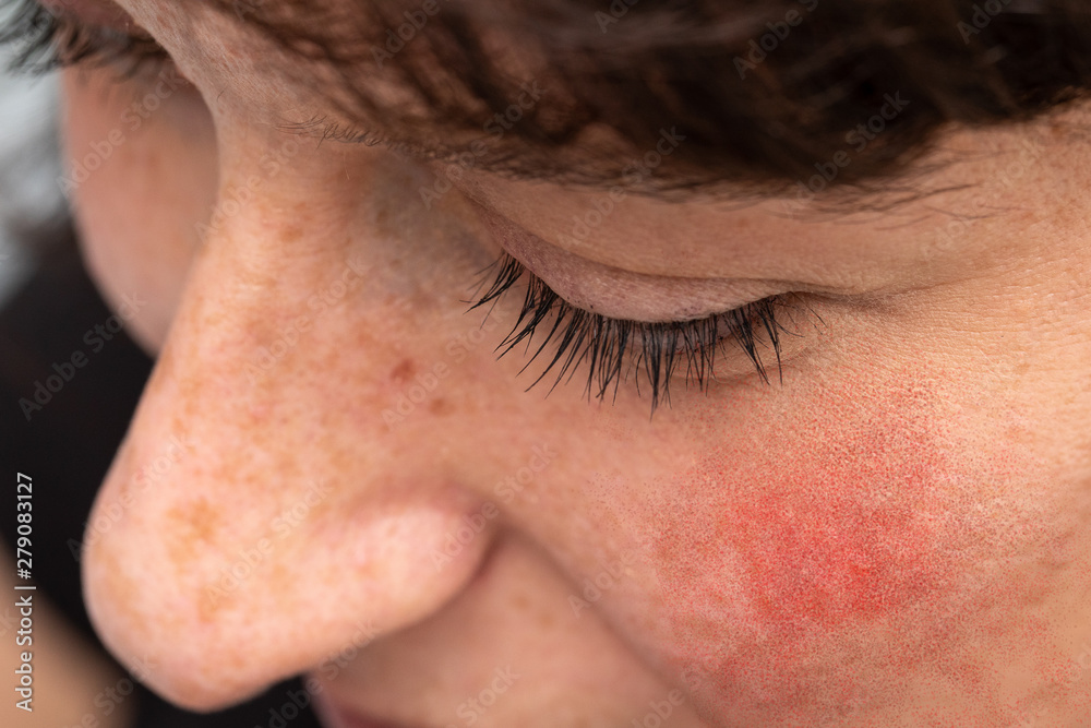 Flushed cheeks in adults