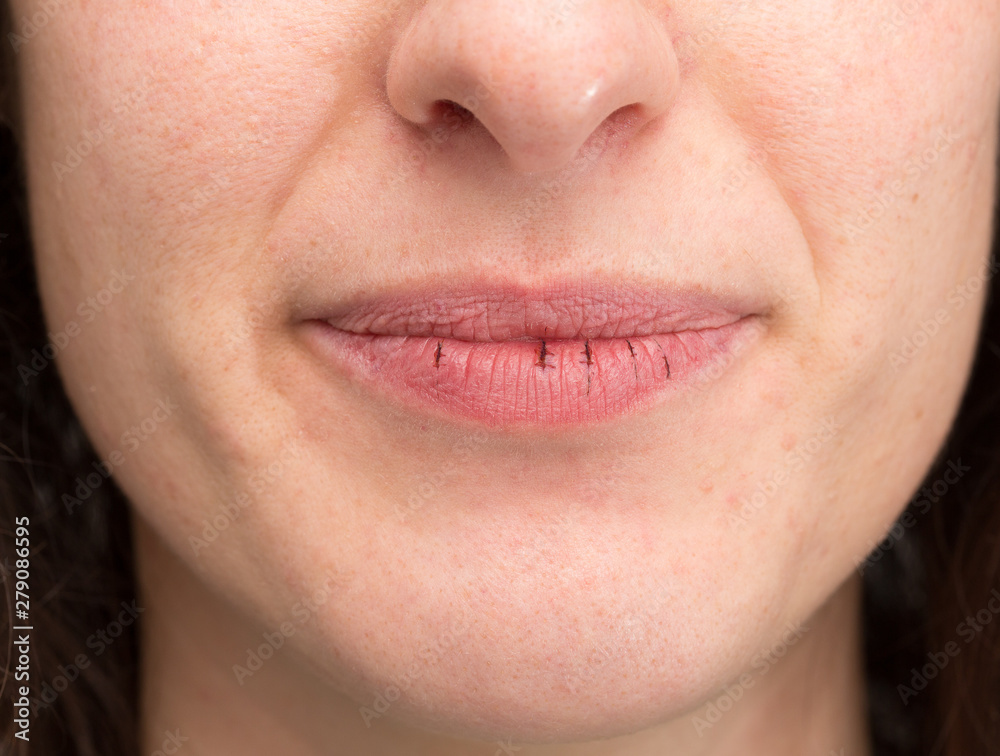 A closeup view on the dry and cracked lips of a Caucasian woman in her late thirties. Symptomatic of dryness from cold weather. A closeup view on the dry and cracked lips of a Caucasian woman in her late thirties. Symptomatic of dryness from cold weather.