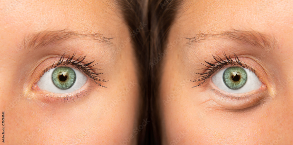 Naklejka premium A before and after view on the green eyes of a pretty Caucasian girl suffering from fluid retention beneath the eye. Results of a successful blepharoplasty.
