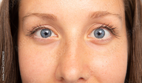 A closeup view of a young and pretty Caucasian woman with blue eyes, suffering from strabismus. A condition that causes the eyes not to align with each other.