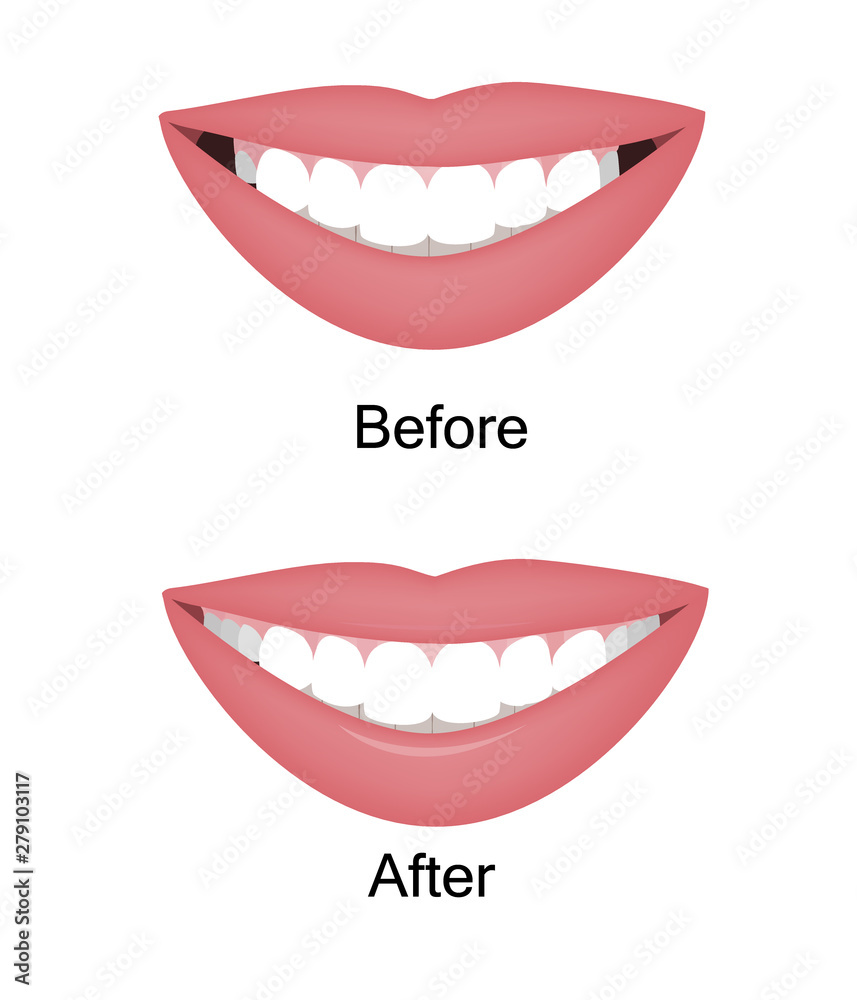 The smile with large and dark buccal corridor before and after
