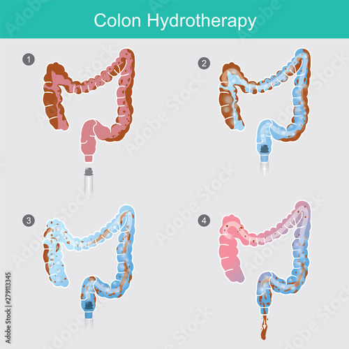 Colon Hydrotherapy..The secreted of waste that accumulates in the colon wall for a long time,.Can use the removal method by inserting water solution hose to flush colon.