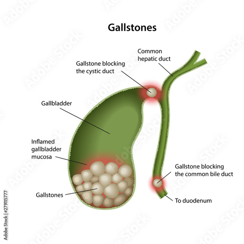 Gallstones in the gallbladder with description of the corresponding parts isolated over white background. Anatomical vector illustration in flat style. photo