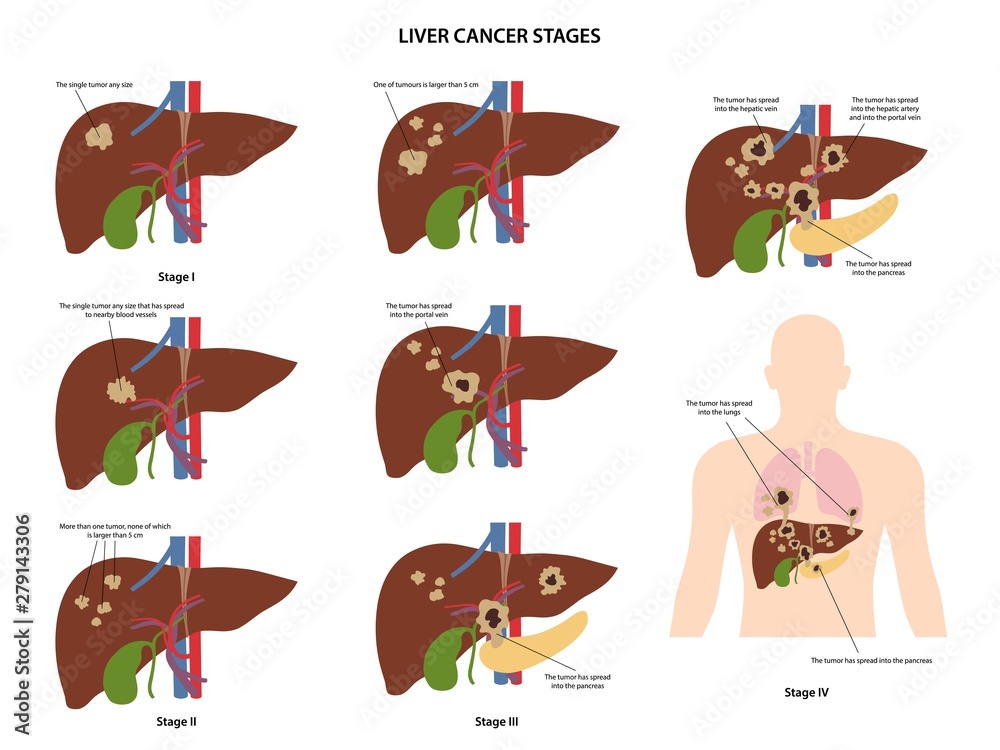 Four stages of liver cancer. Steps spread of tumor. Vector illustration in flat style isolated over white background