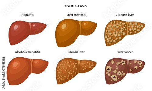 Liver disease: fatty, fibrosis, alcoholic hepatitis, hepatitis, cirrhosis and cancer liver. Anatomical vector illustration in flat style isolated over white background