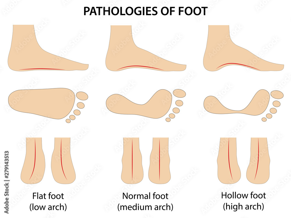 Pathologies of foot. Flat foot. Difference between sick and healthy