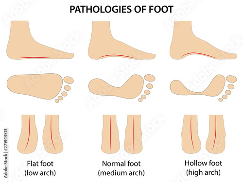 Pathologies of foot. Flat foot. Difference between sick and healthy feet. Vector illustration in flat style over white background